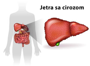 alkoholizam ciroza jetre