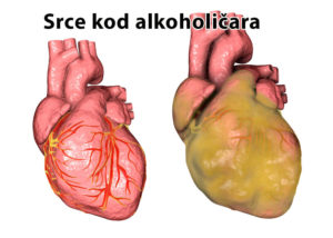 alkoholizam srce problem