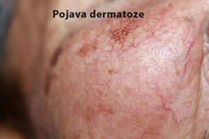 dermatoza alkoholizam