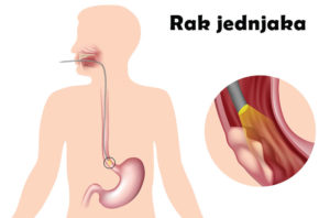 rak jednjaka alkoholizam
