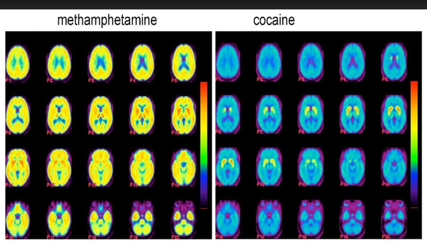 patogeneza bolesti zavisnosti