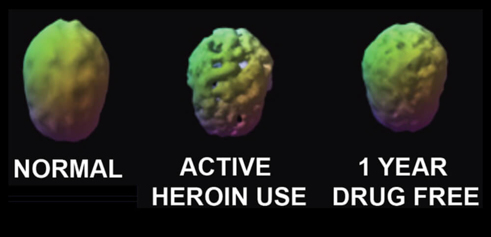 mozak narkomana pre i posle lečenja